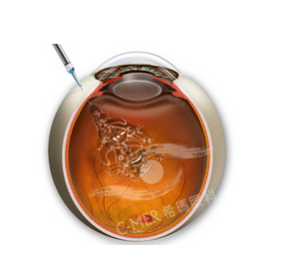 黃斑病變-注射生長因子.png